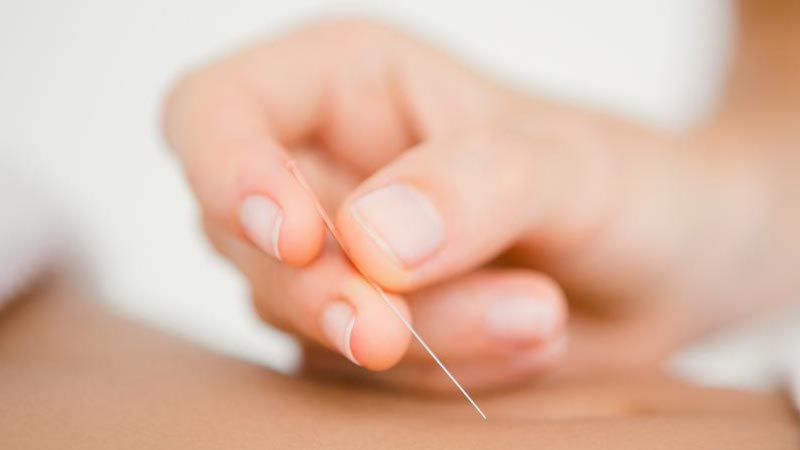 Dry needling for headaches
