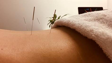 What’s the difference between dry needling and  acupuncture?