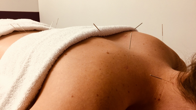 10 things you should know about acupuncture