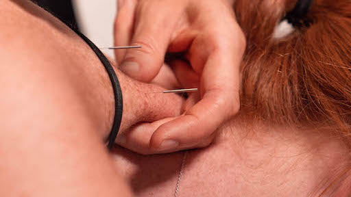 Dry needling versus acupuncture