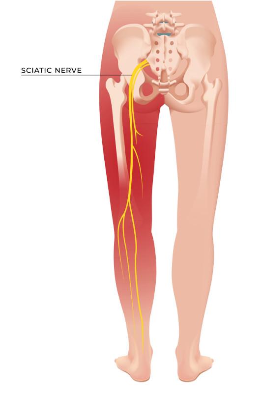 Sciatica